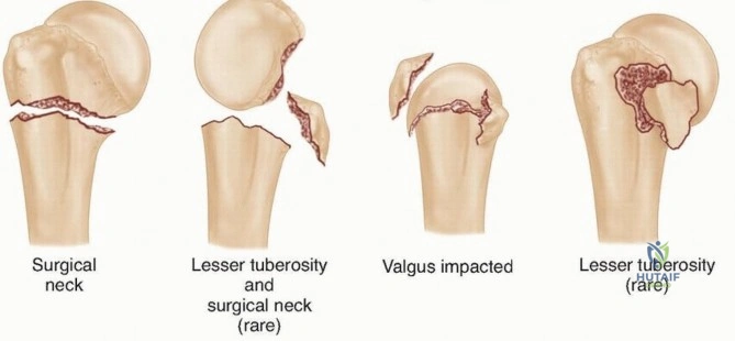 Illustration 3 for Mastering O.R.I.F. for Displaced Proximal Humeral Fractures