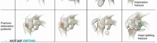 Illustration 3 for Optimize Twopart Surgical Neck Fracture Fixation with IM Nailing