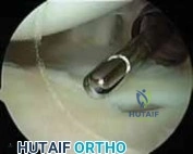 Illustration 4 for Arthroscopic Treatment of Multidirectional Instability: A Test Positive Result Guide
