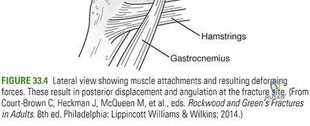 Illustration 4 for Decoding Distal Femur Fractures: Anatomy, Causes & Management