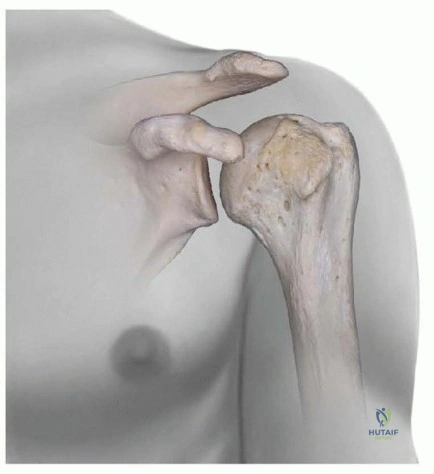 Illustration 4 for Optimize Twopart Surgical Neck Fracture Fixation with IM Nailing