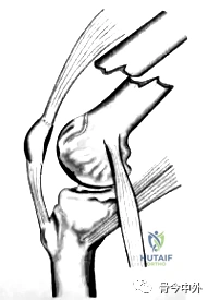 Illustration 4 for 股骨远端骨折挑战重重?c ct mridoppler 精准评估,助您掌握关键固定技巧,确保手术成功与膝关节功能!