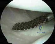 Illustration 5 for Arthroscopic Treatment of Multidirectional Instability: A Test Positive Result Guide