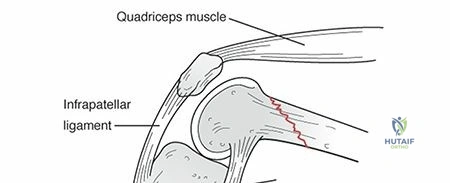 Illustration 5 for Decoding Distal Femur Fractures: Anatomy, Causes & Management