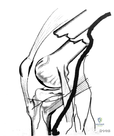 Illustration 5 for 股骨远端骨折挑战重重?c ct mridoppler 精准评估,助您掌握关键固定技巧,确保手术成功与膝关节功能!