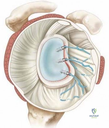 Illustration 6 for Arthroscopic Treatment of Multidirectional Instability: A Test Positive Result Guide