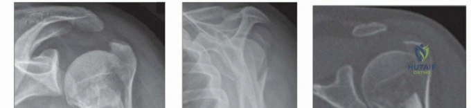 Illustration 6 for Optimize Twopart Surgical Neck Fracture Fixation with IM Nailing