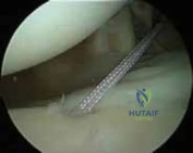 Illustration 7 for Arthroscopic Treatment of Multidirectional Instability: A Test Positive Result Guide