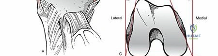 Illustration 7 for Decoding Distal Femur Fractures: Anatomy, Causes & Management