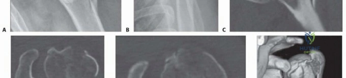 Illustration 7 for Optimize Twopart Surgical Neck Fracture Fixation with IM Nailing