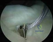 Illustration 8 for Arthroscopic Treatment of Multidirectional Instability: A Test Positive Result Guide