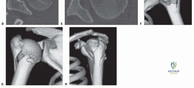 Illustration 8 for Optimize Twopart Surgical Neck Fracture Fixation with IM Nailing