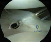 Illustration 9 for Arthroscopic Treatment of Multidirectional Instability: A Test Positive Result Guide