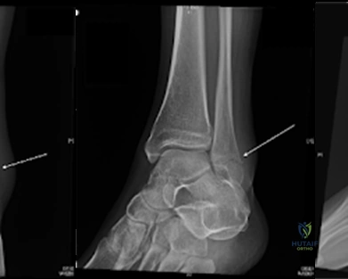Lateral malleolus fracture