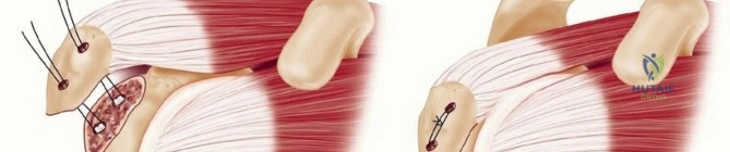 Preoperative Templating