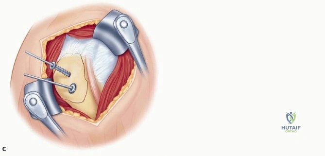 Screw Fixation of Tuberosity