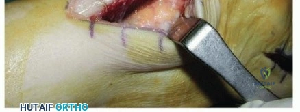Surgical Technique 1