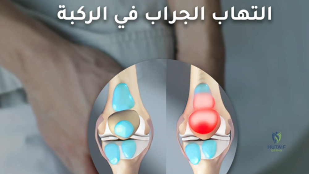 صورة توضيحية 1 لموضوع الجراب في الركبه: دليل الخبراء الشامل لأسباب الألم وعلاجه