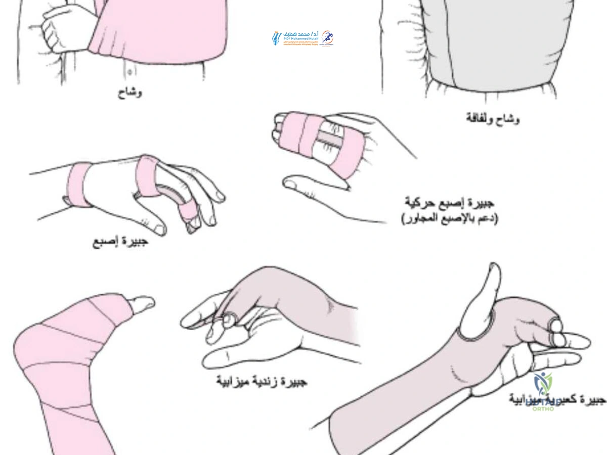صورة توضيحية 1 لموضوع خلع المفصل: الأسباب، الأعراض وعلاج الانخلاع الفعال