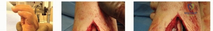 صورة توضيحية 31 لموضوع جراحة تثبيت كسور عظمة الذراع الوسطى: استعادة كاملة لوظائف يدك.