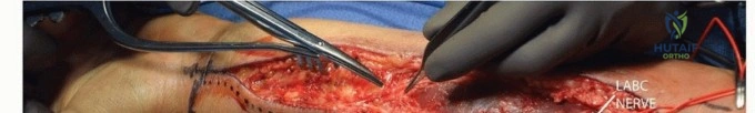 صورة توضيحية 7 لموضوع جراحة تثبيت كسور عظمة الذراع الوسطى: استعادة كاملة لوظائف يدك.