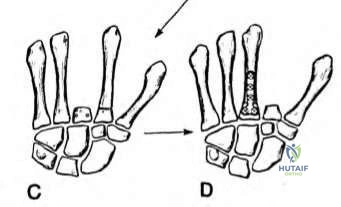 Illustration of hallux mtp joint - Dr. Mohammed Hutaif