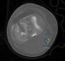 PRP for a 52-Year-Old's Shoulder Pain? Master Ortho MCQs