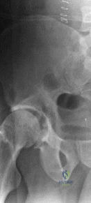Ortho Exam: How to Describe an 84-Year-Old Lady's Shoulder X-ray