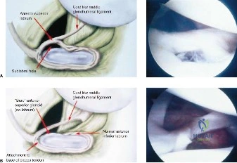 صورة توضيحية لـ تمزق الشفا الحقاني العلوي (SLAP Tear): دليلك الشامل للتشخيص والعلاج في صنعاء مع الأستاذ الدكتور محمد هطيف