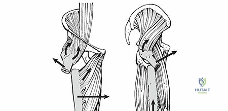 Illustration of subtrochanteric fractures subtrochanteric - Dr. Mohammed Hutaif