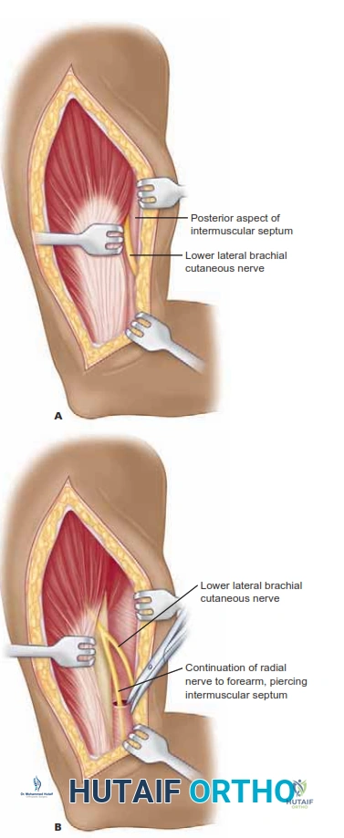 Illustration of lower lateral brachial - Dr. Mohammed Hutaif
