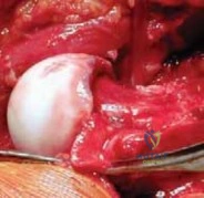 Medial Femoral Circumflex Artery: Critical to Safe Hip Dislocation