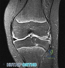 Operative Management of Tarsal Malunions: A Comprehensive Surgical Guide