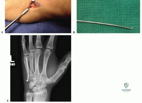 Illustration of lateral collateral ligament - Dr. Mohammed Hutaif