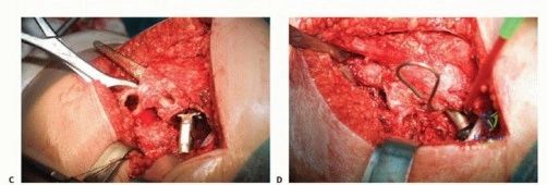 صورة طبية: تقنيات استبدال مفصل الورك الكلي (THA) المتخصصة لتشوهات الورك الشديدة: دليل شامل للمرضى مع الأستاذ الدكتور محمد هطيف