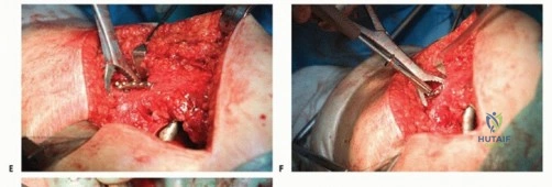 صورة طبية: تقنيات استبدال مفصل الورك الكلي (THA) المتخصصة لتشوهات الورك الشديدة: دليل شامل للمرضى مع الأستاذ الدكتور محمد هطيف