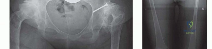 صورة طبية: تقنيات استبدال مفصل الورك الكلي (THA) المتخصصة لتشوهات الورك الشديدة: دليل شامل للمرضى مع الأستاذ الدكتور محمد هطيف