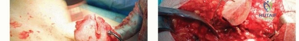 صورة طبية: تقنيات استبدال مفصل الورك الكلي (THA) المتخصصة لتشوهات الورك الشديدة: دليل شامل للمرضى مع الأستاذ الدكتور محمد هطيف