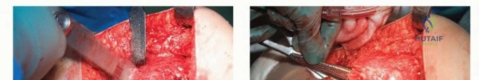 صورة طبية: تقنيات استبدال مفصل الورك الكلي (THA) المتخصصة لتشوهات الورك الشديدة: دليل شامل للمرضى مع الأستاذ الدكتور محمد هطيف