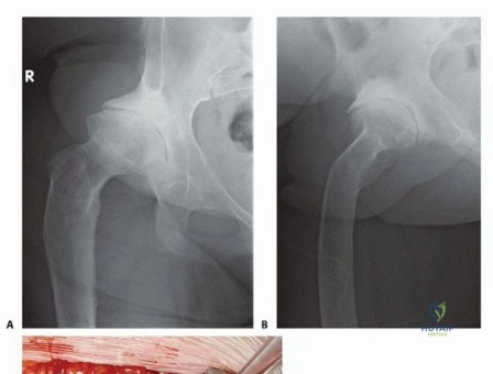 صورة طبية: تقنيات استبدال مفصل الورك الكلي (THA) المتخصصة لتشوهات الورك الشديدة: دليل شامل للمرضى مع الأستاذ الدكتور محمد هطيف