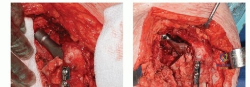 صورة طبية: تقنيات استبدال مفصل الورك الكلي (THA) المتخصصة لتشوهات الورك الشديدة: دليل شامل للمرضى مع الأستاذ الدكتور محمد هطيف