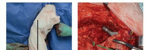 صورة طبية: تقنيات استبدال مفصل الورك الكلي (THA) المتخصصة لتشوهات الورك الشديدة: دليل شامل للمرضى مع الأستاذ الدكتور محمد هطيف