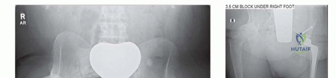 صورة طبية: تقنيات استبدال مفصل الورك الكلي (THA) المتخصصة لتشوهات الورك الشديدة: دليل شامل للمرضى مع الأستاذ الدكتور محمد هطيف