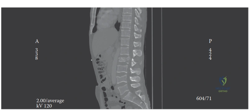 Illustration of thoracolumbar spine injury - Dr. Mohammed Hutaif