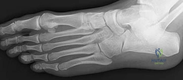 Timing and Techniques in Peripheral Nerve Repair: A Comprehensive Surgical Guide