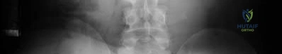 TKR in patients with HIV and hepatitis C