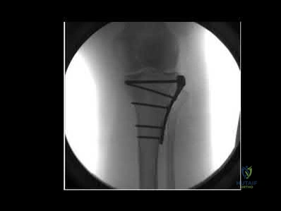 Congenital Hand Reconstruction: Toe-Phalanx Transplantation and Ring Syndrome
