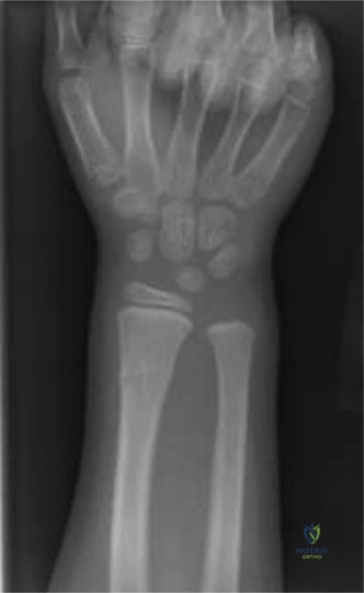 Illustration of velcro wrist brace - Dr. Mohammed Hutaif
