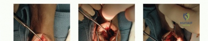 Operative Management of Median Nerve Palsy: Tendon Transfers for Thumb Opposition