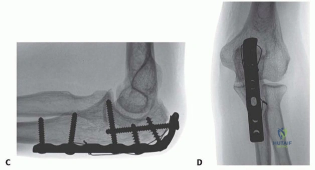 Mastering the Management of Tibial Shaft Fractures: Cast Bracing and Plate Osteosynthesis